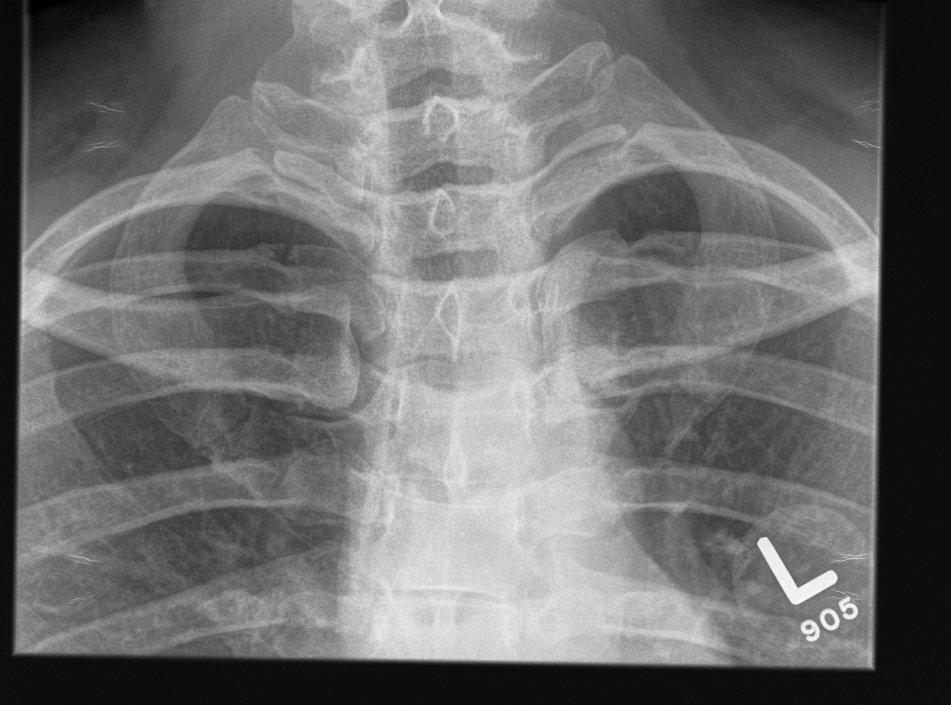 Condensing Osteitis Xray